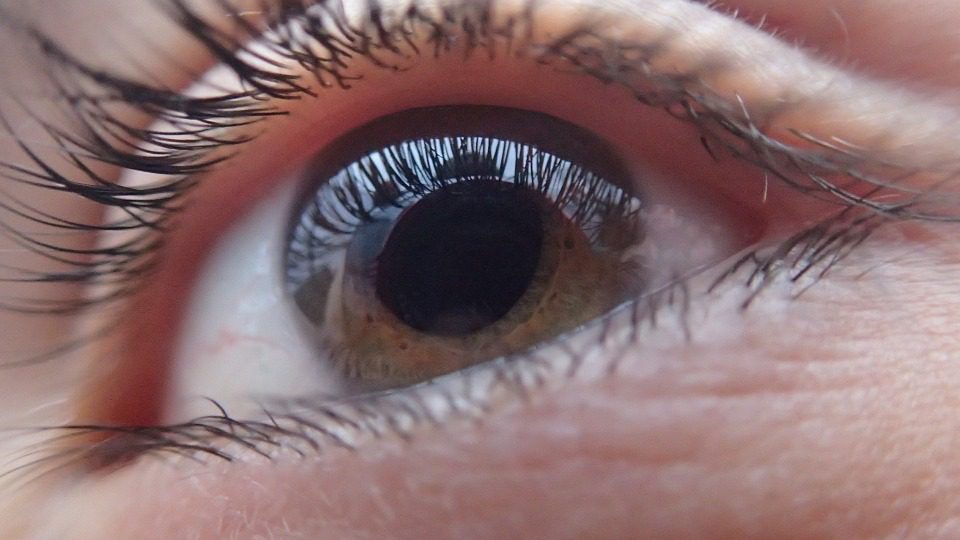 Imagen de ojo color marrón presentando la enfermedad visual "glaucoma", donde pareciera que la pupila se encuentra dilatada, pero realmente muestra la presión ocular. 