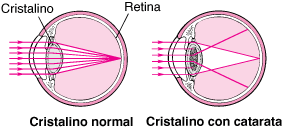 La diferencia entre cristalino normal y cristalino con catarata