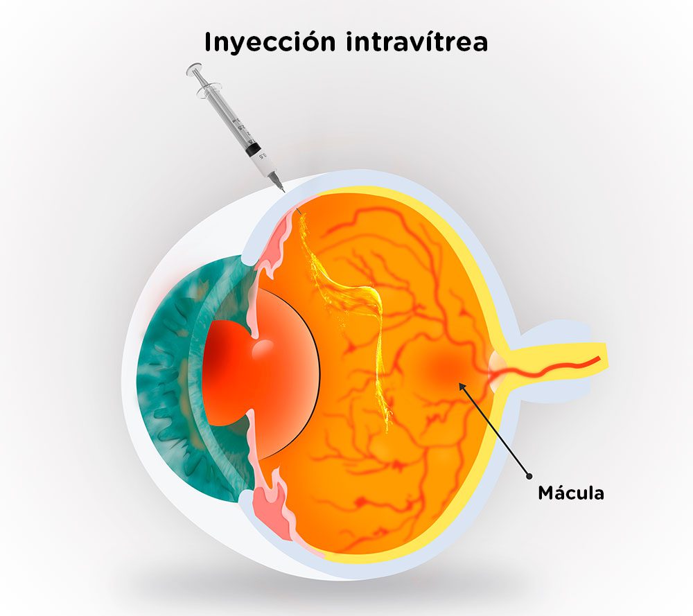 Procedimiento de las inyecciones intravítreas en los ojos