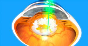 Cirugía iridotomía con láser para tratar glaucoma en salauno