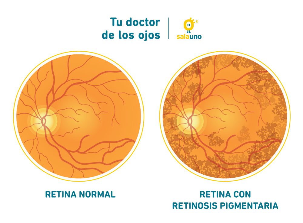 retina con retinosis pigmentaria salauno