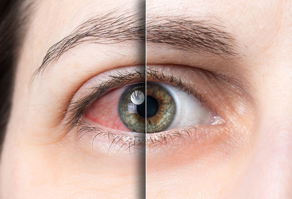 Tabaquismo y enfermedades oculares: ojo seco